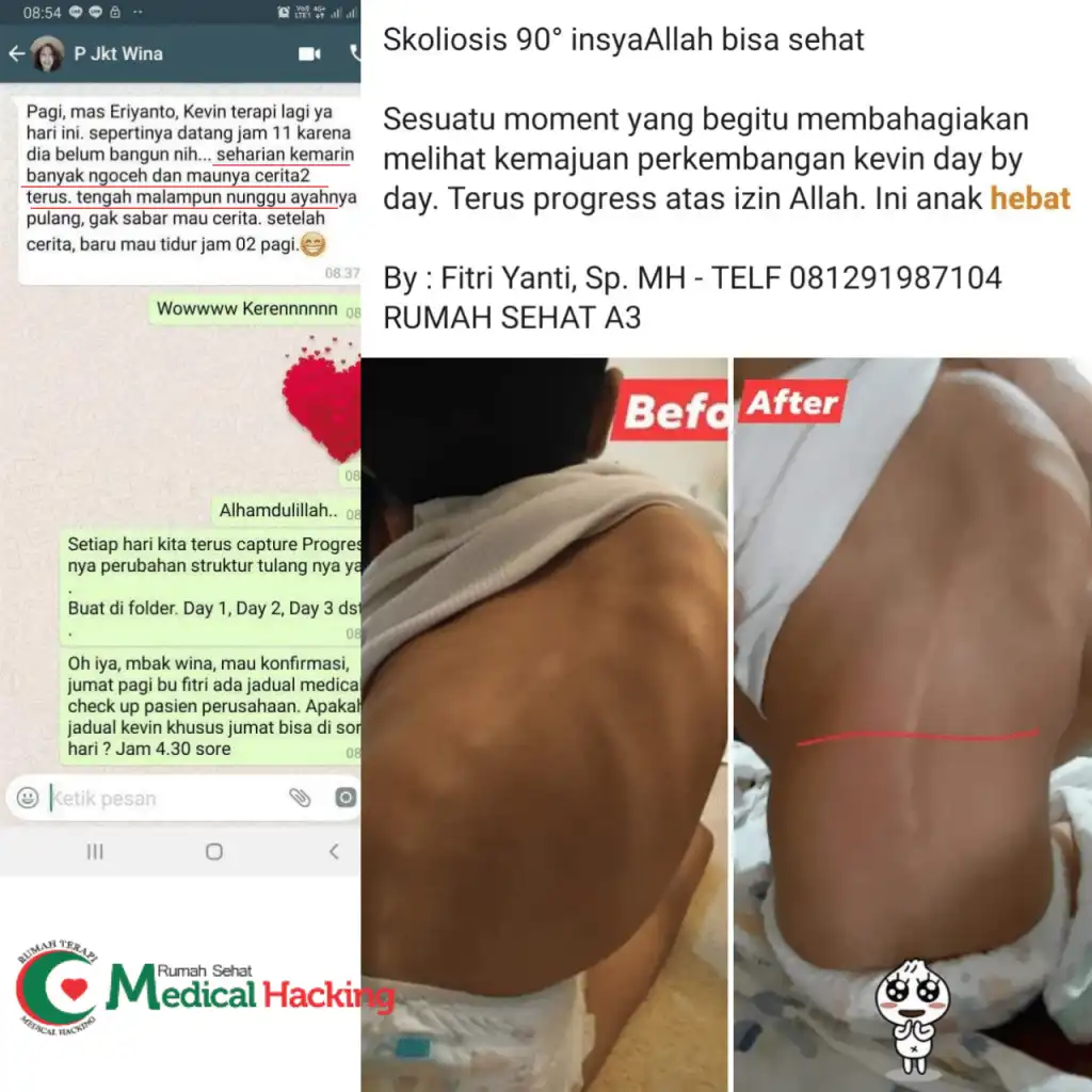 testimoni pasien anak skoliosis 90 derajat rs medical hacking