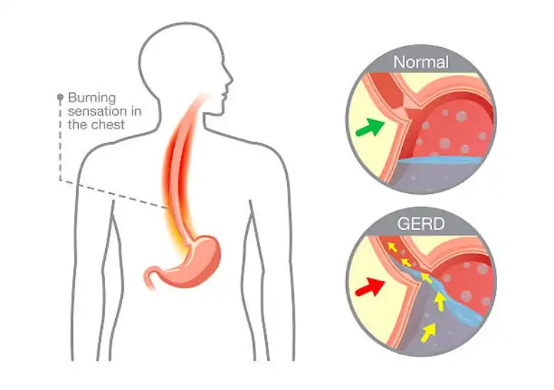 Alur-GERD-MEDICAL-HACKING